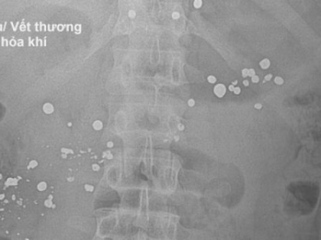 Cành cây rơi khiến súng phát nổ, người đàn ông dính 15 viên đạn Cành cây rơi khiến súng phát nổ, người đàn ông dính 15 viên đạn