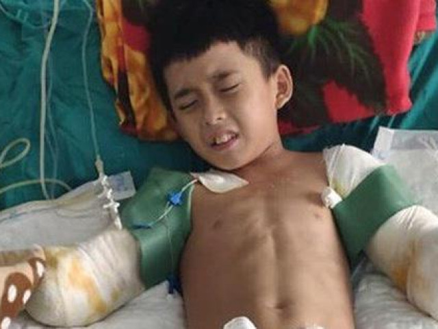 Mất đôi tay, cậu bé 12 tuổi bị điện giật chỉ mong giữ được đôi chân